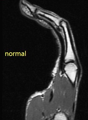 Figure 4 for case A2 pulley rupture finger (RID2437)